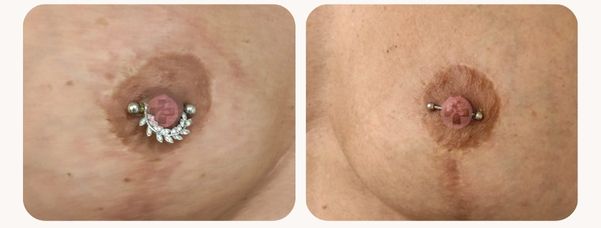 areola micropigmentacion barcelona